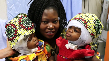 Սիամական երկվորյակներին բաժանել են․ 18 ժամանոց բացառիկ վիրահատություն՝ Իտալիայում 