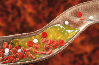 Մասնագետը նշել է պարզ միջոց առանց դեղամիջոցների խոլեստերինի մակարդակը նվազեցնելու համար
