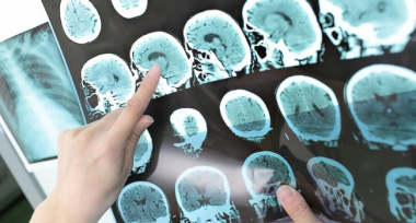 Նոր դեղամիջոցը կարող է արդյունավետ լինել Ալցհեյմերի հիվանդության դեպքում