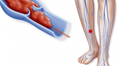 COVID-19-ի հետևանքով առաջացած թրոմբոզն ախտորոշելու նոր միջոց է գտնվել