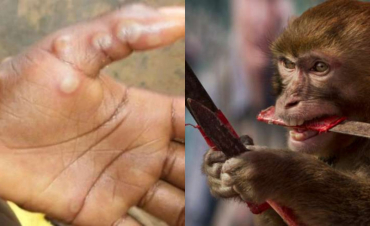 Կապիկի ծաղիկ հիվանդության 338 դեպքերը հաստատվել են 20 ոչ էնդեմիկ երկրում