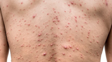 Անհանգստացնող բռնկումներ չկան. Առողջապահության նախարարությունը հորդորում է չաղավաղել տեղեկատվությունը