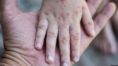 Հնդկաստանում «Կապիկի ծաղիկ» կոչվող հիվանդության հայտնաբերման առաջին կասկածներն են ի հայտ եկել