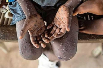 Եգիպտոսում գրանցվել է կապիկի ծաղիկի առաջին դեպքը