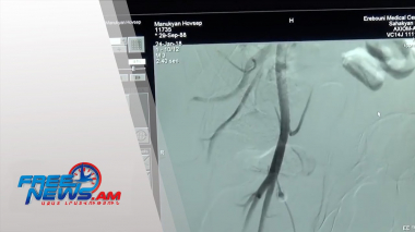 Գլխուղեղի սուր իշեմիկ կաթվածի բուժման ծրագրի արդյունքները