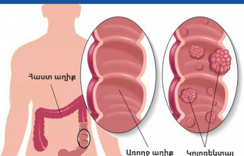 Երևանում և Գյումրիում կոլոռեկտալ քաղցկեղի վաղ հայտնաբերման անվճար սքրինինգային փորձարարական ծրագիր է իրականացվում
