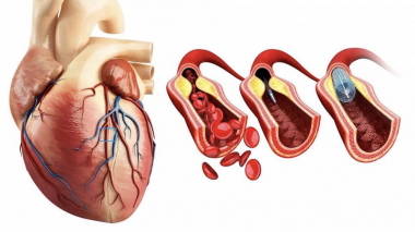 Հայաստանում Stent for life ծրագրի շրջանակում մատուցվել է 14893 ծառայություն