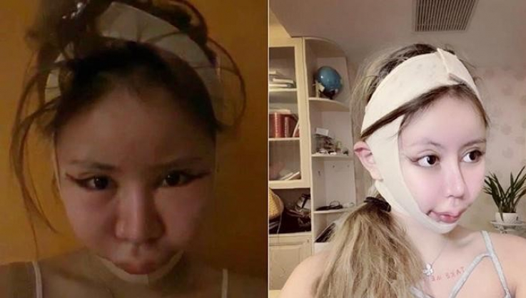 16-ամյա չինուհին 100 պլաստիկ վիրահատություն է արել՝ արտաքին տեսքը բարելավելու համար (լուսանկարներ)